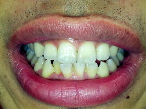 牙齿上出现小白点(牙齿上出现小白点，应该注意什么？保护牙齿的方法有哪些？)