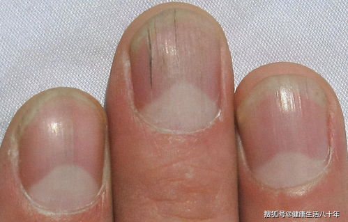 指甲有竖纹是身体有大病的征兆吗(指甲上有竖纹这一现象，是不是身体有病的征兆？)
